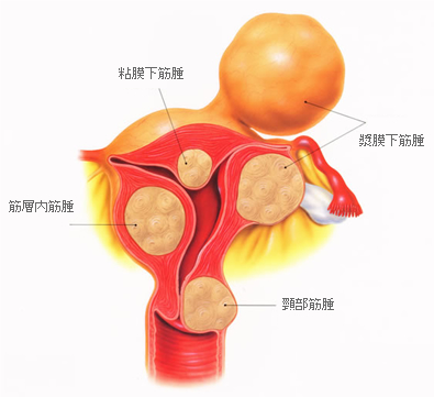 子宮筋腫