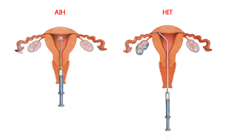 AIH、HIT　イラスト図